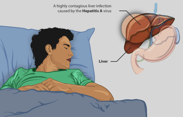 Hepatit ile ilgili bilgilendirici illüstrasyon (temsili).