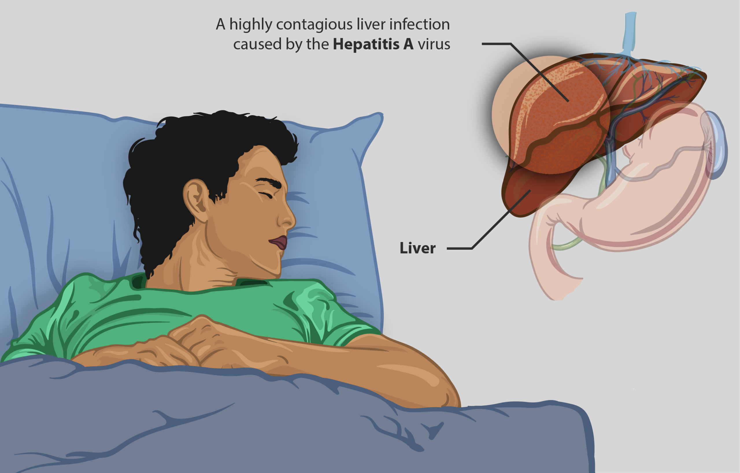 Hepatit ile ilgili bilgilendirici illüstrasyon (temsili).
