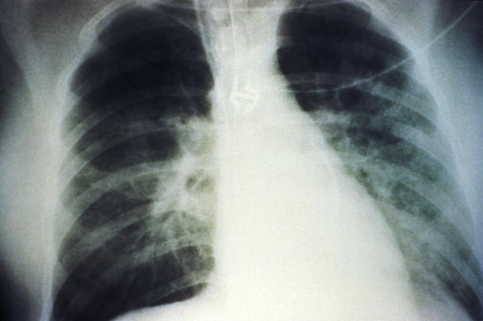 CDC arşivinden hantavirüsle ilişkili bir akciğer röntgeni görüntüsü (temsili, arşiv).